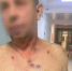 В мужчину стреляли дробью в Киреевском районе Тульской области - ИА Тульская служба новостей