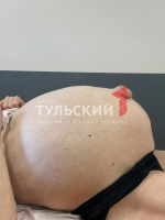 Женщина из Ефремова несколько лет ходила с 35-килограммовой опухолью