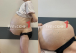 Женщина из Ефремова несколько лет ходила с 35-килограммовой опухолью